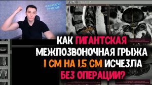 Грыжа гигант 1см на 1.5 см ушла без всего! КАК?