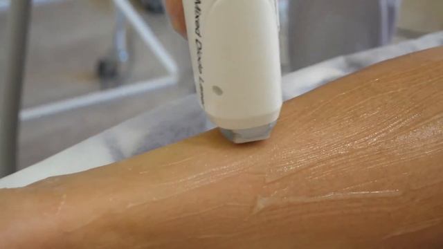 Екатерина Гибридная Диодная Лазерная эпиляция смотреть онлайн