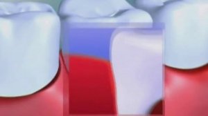 Метрогил Дента