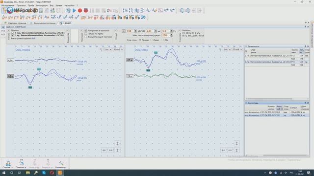 Глазные (окулярные) вестибулярные миогенные вызванные потенциалы (ВМВП) смотреть онлайн