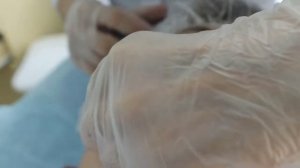 Контурная пластика   поднятие уголков губ