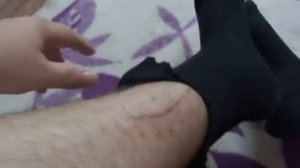 перелом берцовой кости реобилитацыя