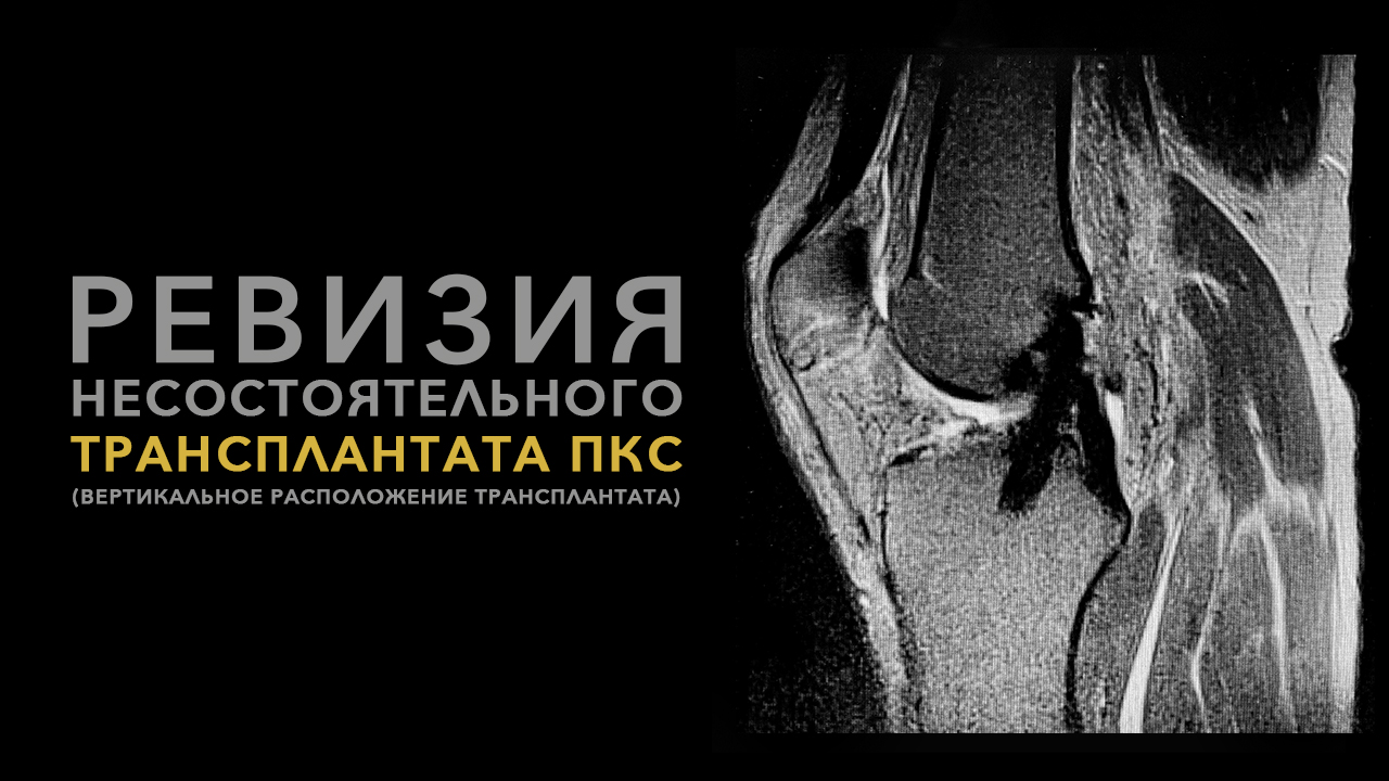 Ревизия несостоятельного трансплантата ПКС (вертикальное расположение трансплантата)