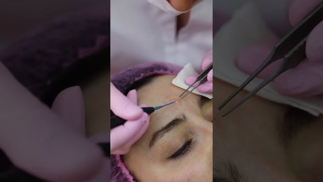 Удаление родинки смотреть онлайн