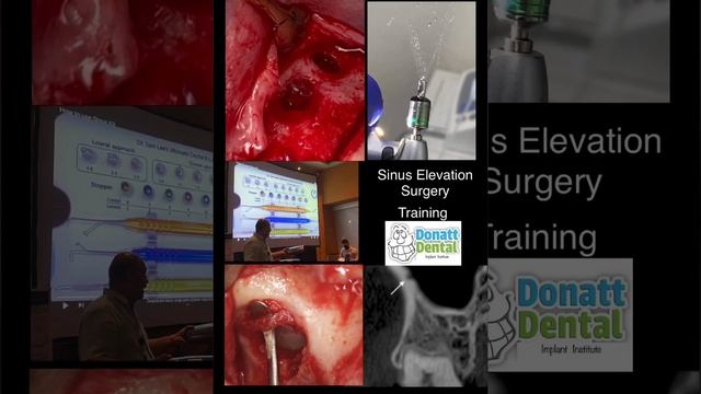 Sinus Lift surgery Lateral window approach, for Dental professionals only.