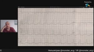 Разбор ЭКГ №4