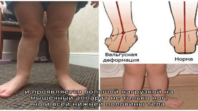 Массаж при вальгусе стоп у ребенка