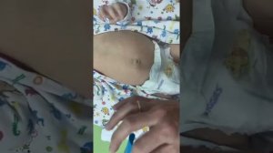 Тейпирование пупочной грыжи у грудничков