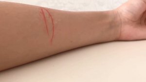 Первичная хирургическая обработка раны( описание под видео)