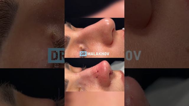 Первичная риносептопластика 😍 Еще больше работ в ТГ-канале https://t.me/+6StkhDkKwg0yMGNi