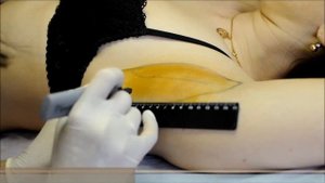 Лечение гипергидроза в медицинском центре "АртМедика"