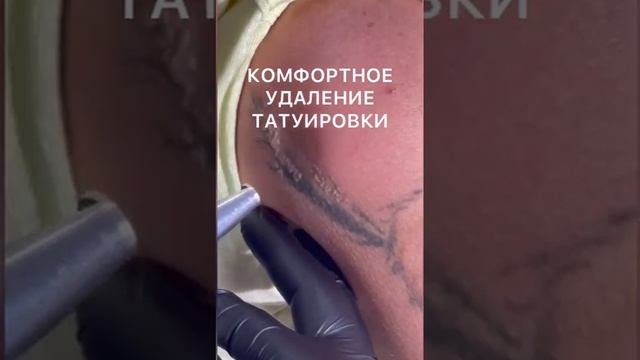 Удаление татуировок лазером, Алматы, Казахстан. смотреть онлайн