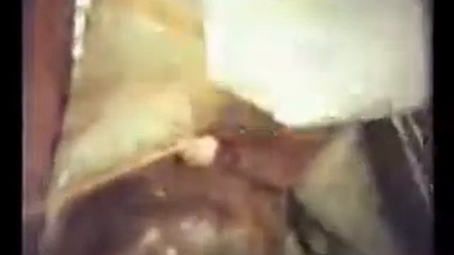 Ретроградная аппендэктомия русский