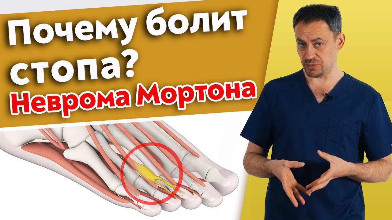 Как вылечить боль в стопе? / Что такое неврома Мортона?