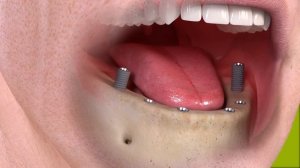 Как происходит процедура несъемного протезирования на 6 имплантатах