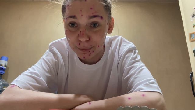 Как лечить ветрянку у взрослых #ветрянка #взрослыйсветрянкой