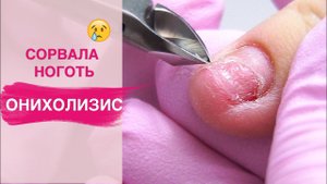 Сорвала ноготь  Убираем ОНИХОЛИЗИС ногтей на руках