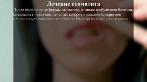 Стоматит: причины, симптомы, лечение заболевания.