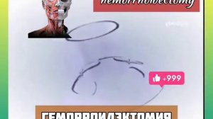 Современное лечение геморроя, Геморроидэктомия, Латексное лигирование..mp4