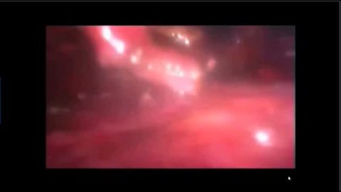 Симпатэктомия: эндоскопическая поясничная и грудная симпатэктомия