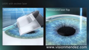 LASIK vs FEMTO-LASIK