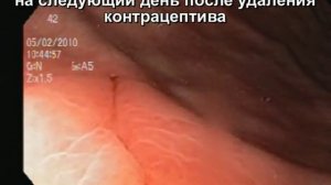 Внутриматочная спираль была удалена через ж... .
