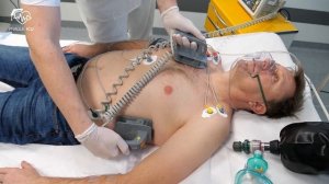 Electrical cardioversion