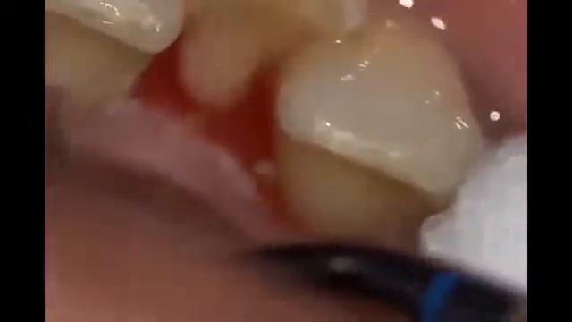 Чистка зубов ультра звуком смотреть онлайн