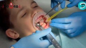 ФИКСАЦИЯ КОРОНКИ НА МОЛОЧНЫЙ ЗУБ