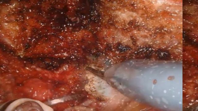 Alessandro Antonelli - Robotic revision of urethro-vesical stricture after RARP смотреть онлайн