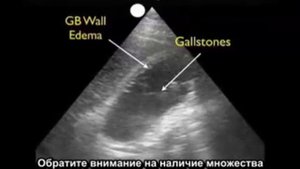 Порядок выполнения: ультразвуковое исследование желчного пузыря, часть 3 — холецистит