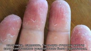 Облазит кожа на пальцах рук у ребенка — причины