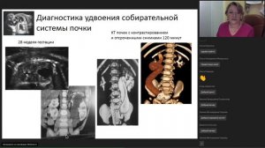 Антенатальная диагностика пороков мочевыводящей системы - Левитская М. В.