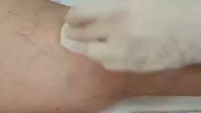 СКЛЕРОТЕРАПИЯ ХОД ПРОЦЕДУРЫ