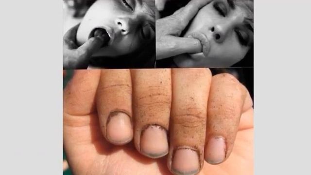 Без кусачек обойдемся: почему Киркоров, Хилтон и другие не могут перестать грызть ногти смотреть онлайн