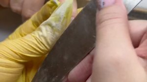 Сорвала ноготь в обратную сторону | Жуть как больно и страшно?Поднятие клюющих ногтей