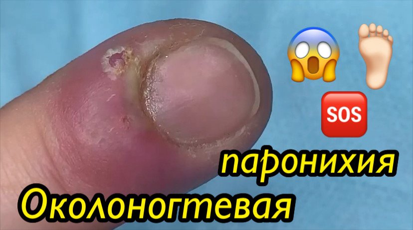 Околоногтевая паронихия ??⚠️❗️??