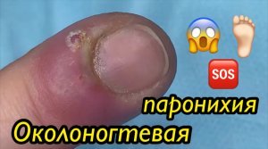 Околоногтевая паронихия ??⚠️❗️??