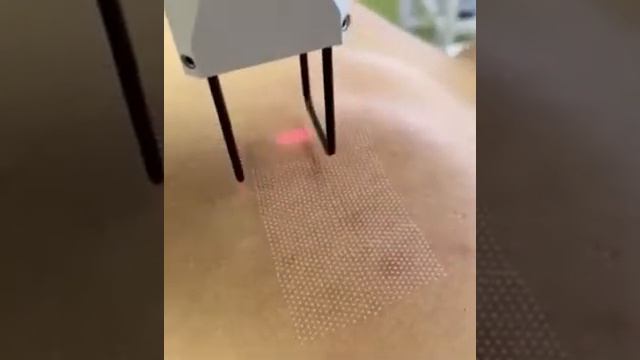 Лечение рубцов пост-акне. Фракционный лазер смотреть онлайн