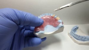 частично съёмный зубной протез из термопласта
