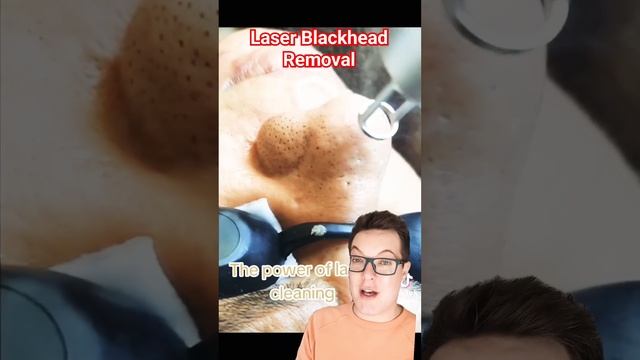 ? CRAZY LASER BLACKHEAD REMOVAL - This Cant Be Real!! #shorts