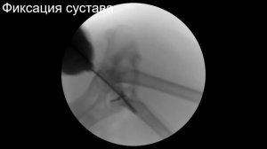 Вправление и фиксация вывиха тазобедренного сустава у пинчера.