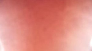 4 (4) Три полные эрозии антрального отдела желудка