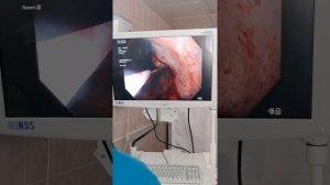 Эндоскопическая полипэктомия в желудке