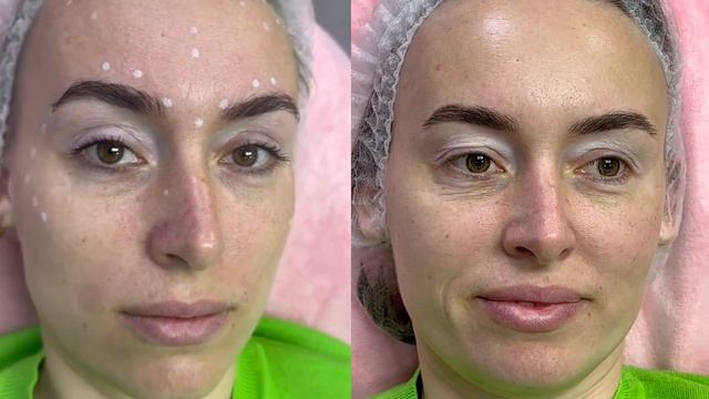 До и после ботокса. смотреть онлайн