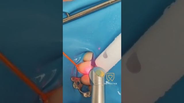 Реставрация фронтальной группы зубов