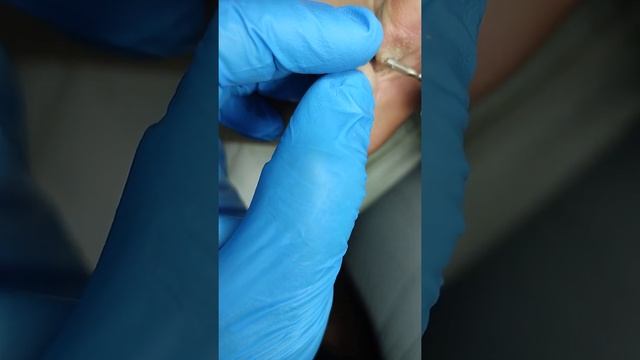 Межпльцевая мозоль