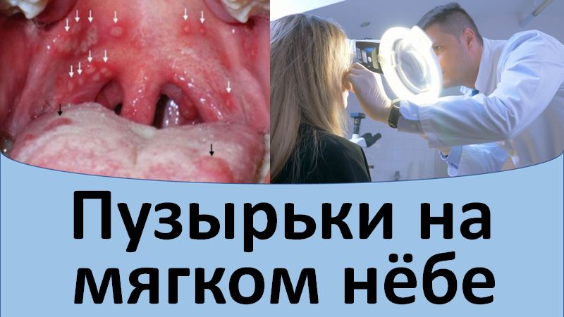 Пузырьки на мягком нёбе