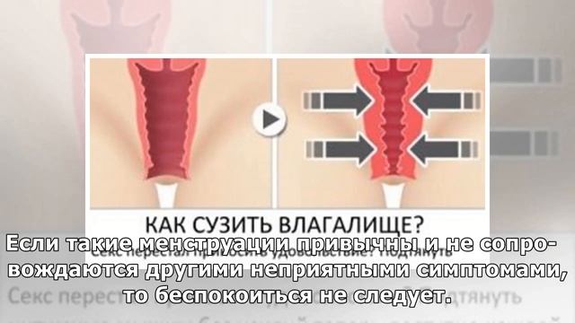 Как отличить маточное кровотечение от обильных месячных? смотреть онлайн