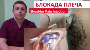 Блокада плечевого сустава Боль в плече Shoulder Pain Injection